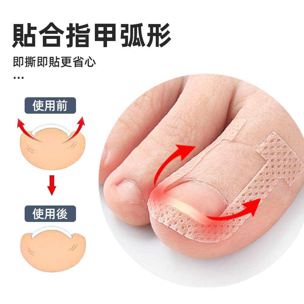 【上手家居】甲溝炎正甲貼 40貼組-40片組(凍甲/嵌甲/卷甲/嵌甲貼片/腳趾甲貼片), , large