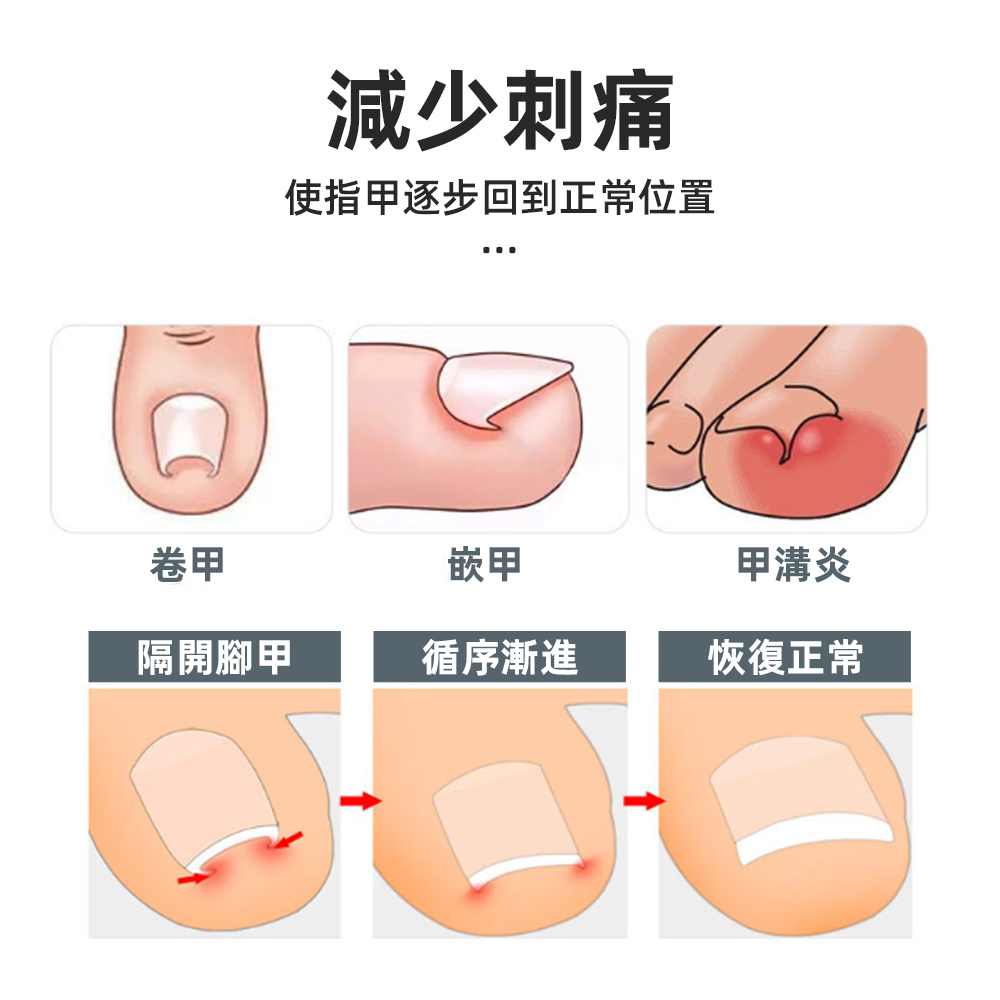 【上手家居】甲溝炎正甲貼 40貼組-40片組(凍甲/嵌甲/卷甲/嵌甲貼片/腳趾甲貼片), , large