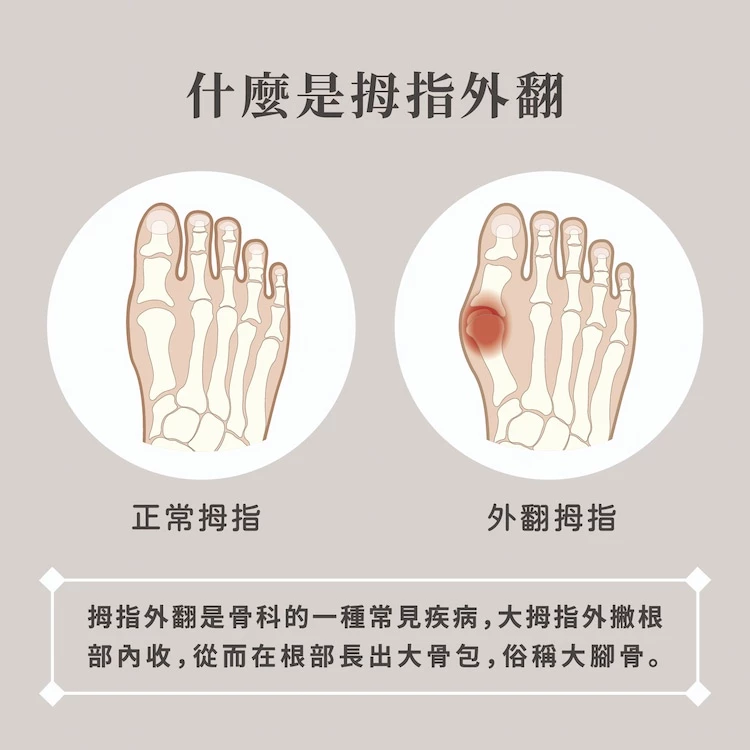 Daily use hallux valgus pads, , large